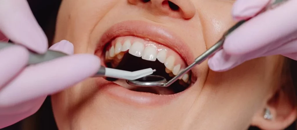 How Come Some People Get Cavities Easier Than Others?