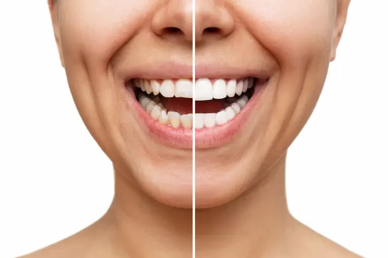 A before-and-after image of porcelain veneers added to the teeth of a dental patient.