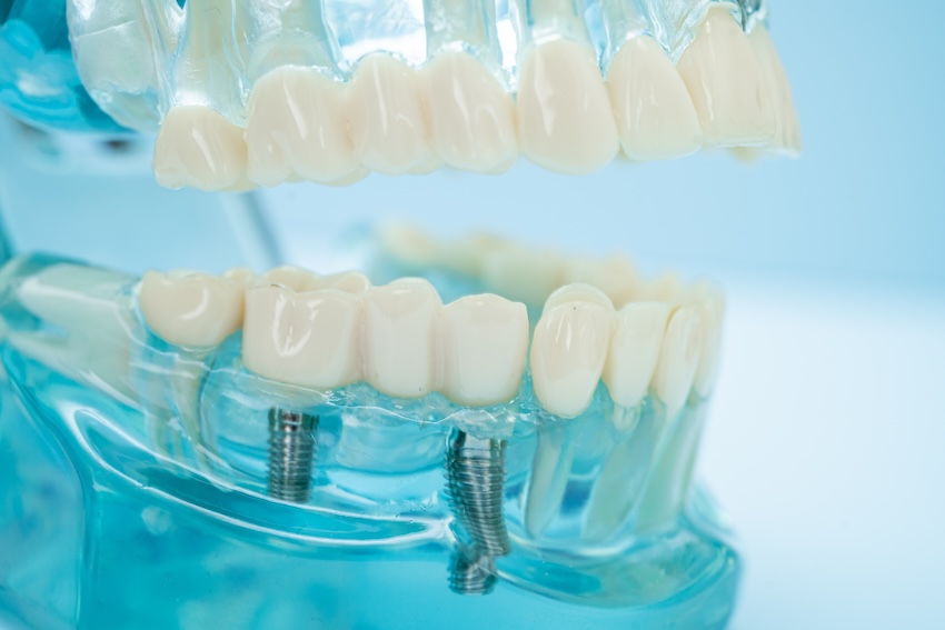 norfolk dental implants