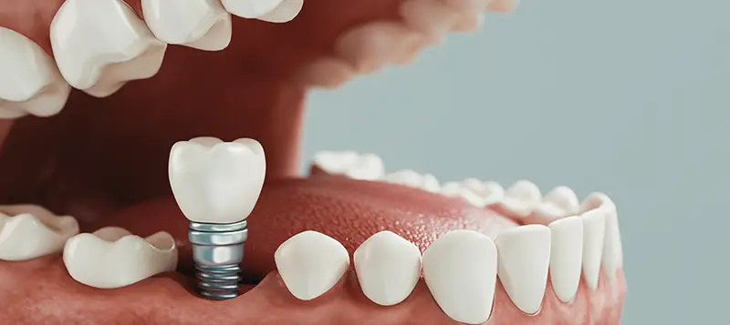 Dr. Adam Foleck placing a dental implants at The Foleck Center in Virginia Beach, VA