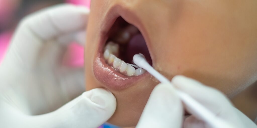 Fluoride Treatments