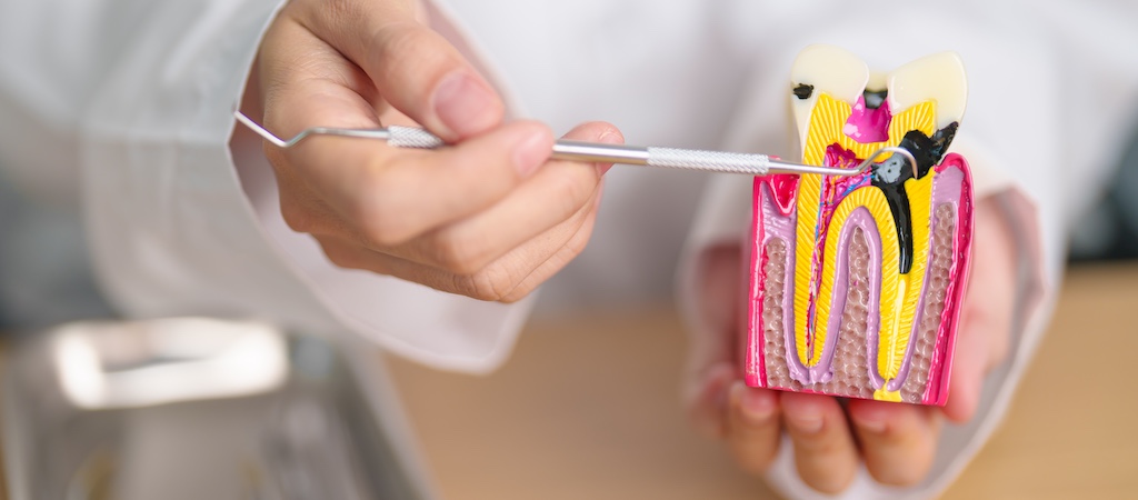 Root Canals