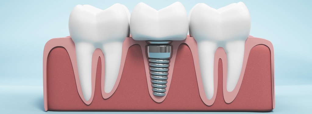 3D illustration features a molar tooth, highlighting its enamel and root structure. Implant image for dental, healthcare, and educational content focused on oral hygiene and treatment.