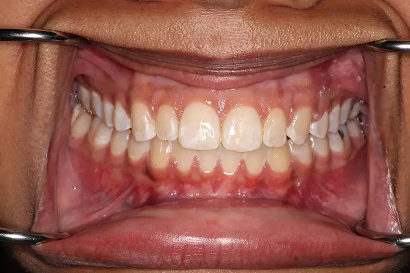 smile with straight teeth