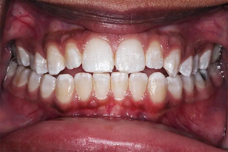 Crooked smile from the front