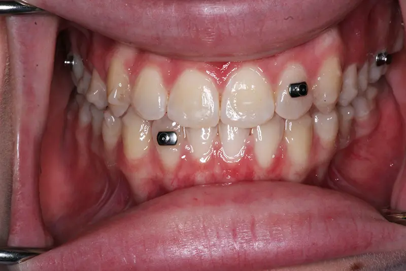 smile straightened by Invisalign