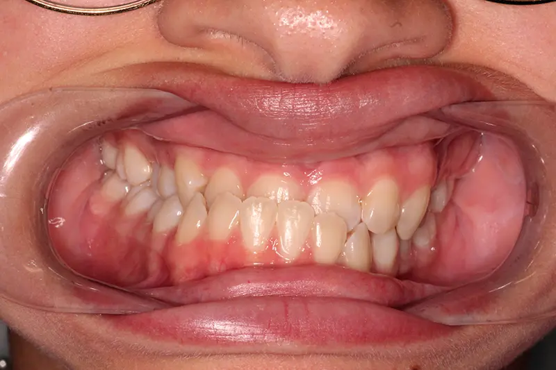 crooked smile with underbite