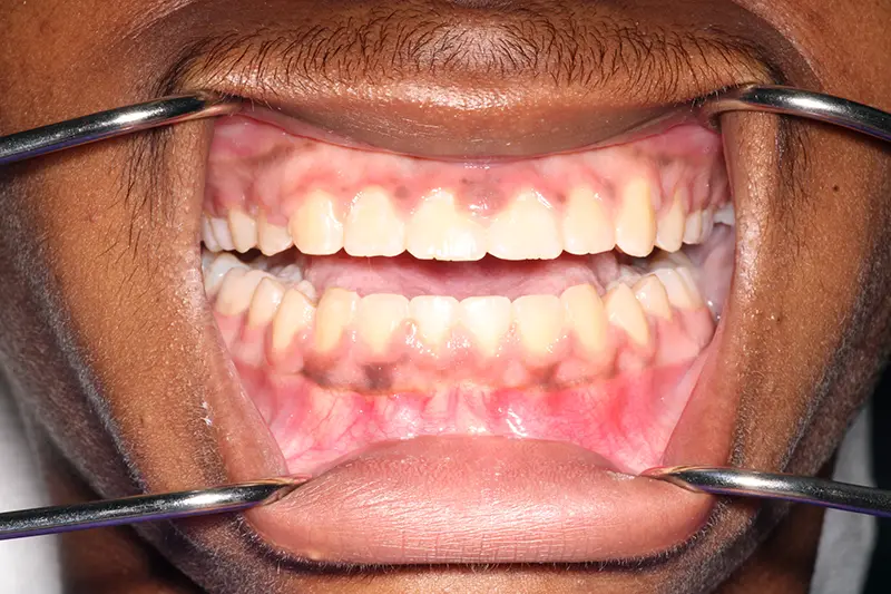 straightened smile