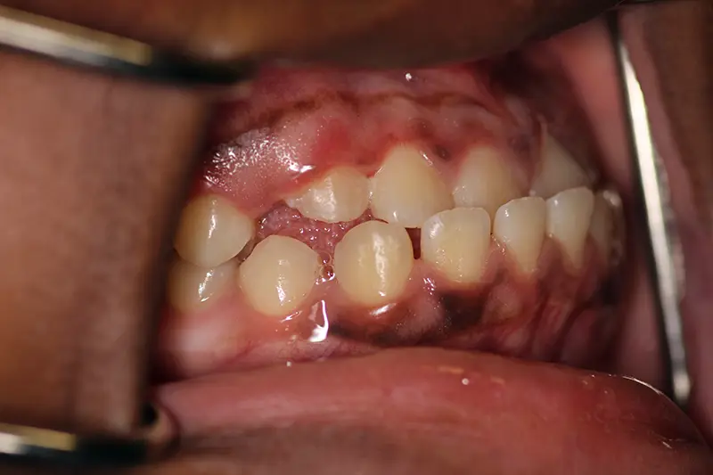 Crooked smile from the right side